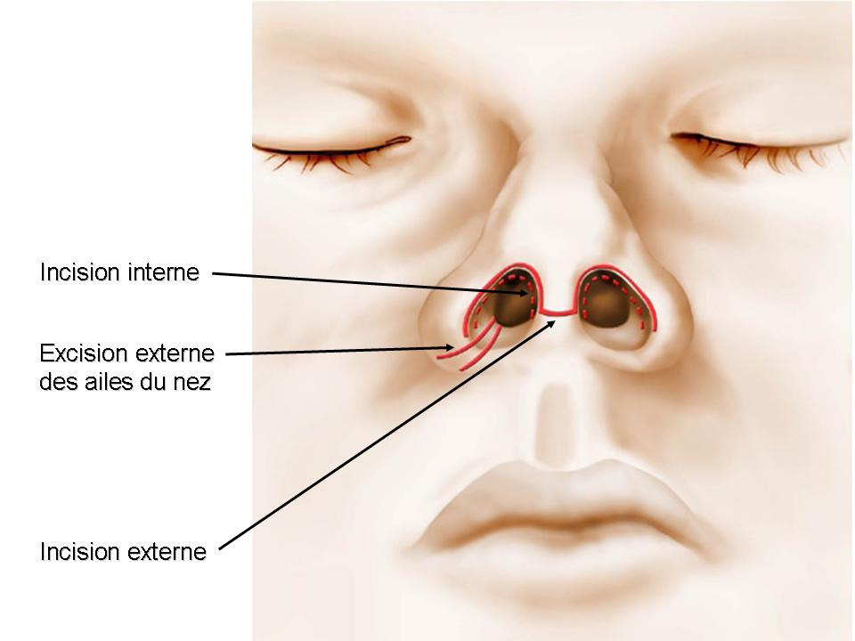 Incision de la rhinoplastie