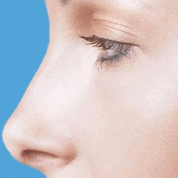 Technique utilisée pour la Rhinoplastie