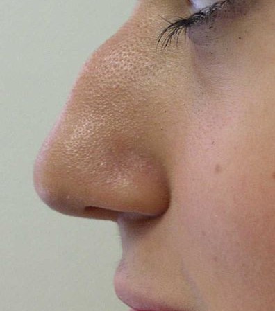 Quelles corrections la rhinoplastie peut apporter ?